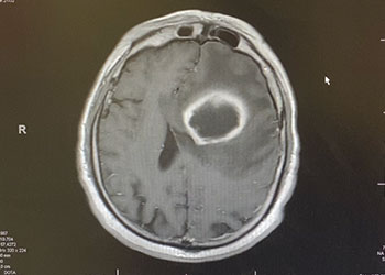 BrainAbscess FeaturedImage