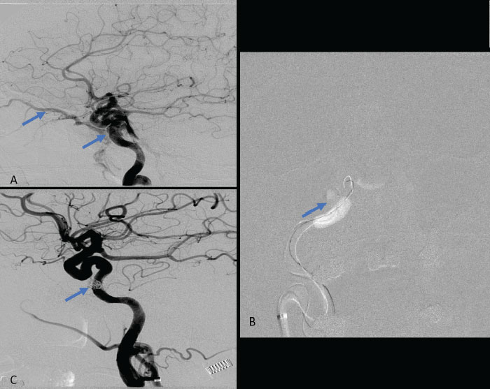 Carotid Cavernous Fistula (CCF) Study 1