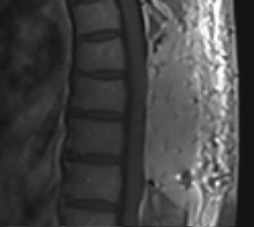 Postoperative MRI T1w demonstrating a gross total resection