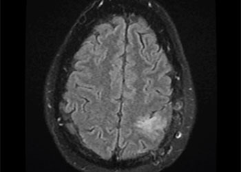 Grade II Oligodendroglioma feature