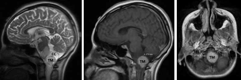 Hemangioblastoma 1