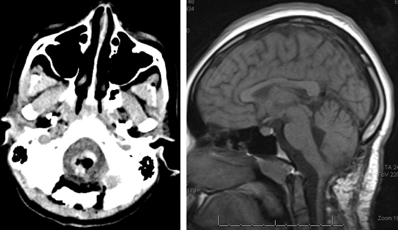 Hemangioblastoma 3