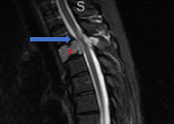 Spinal Embo T3 Figure 1A feature