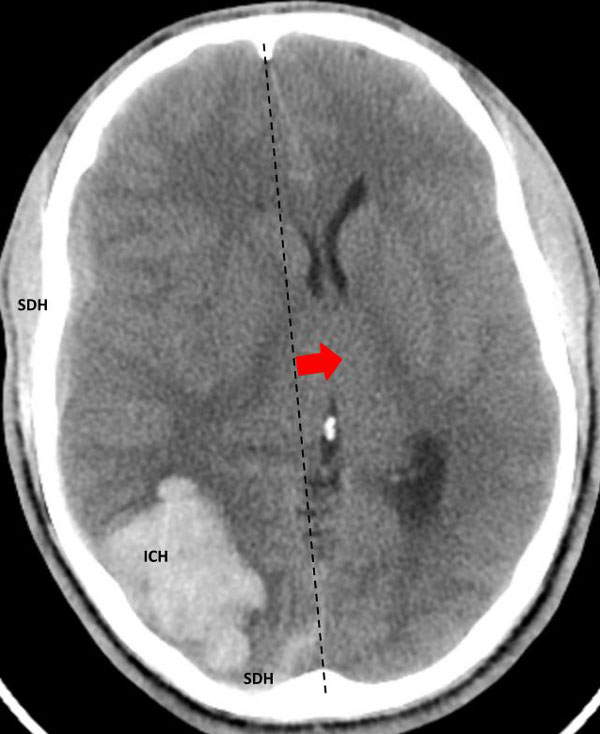 Young college student with severe headache and a large intracerebral bleed 1