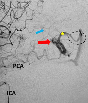 Young college student with severe headache and a large intracerebral bleed 3