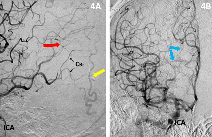 Young college student with severe headache and a large intracerebral bleed 4