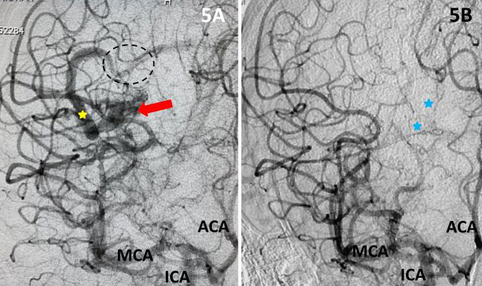 Young college student with severe headache and a large intracerebral bleed 5