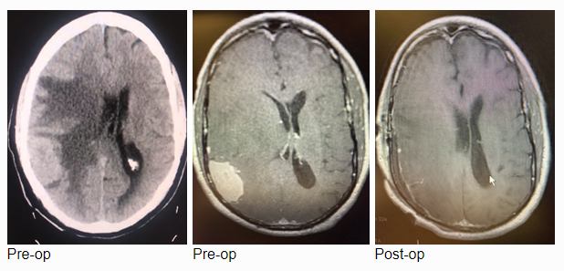 Atypical Convexity Meningioma