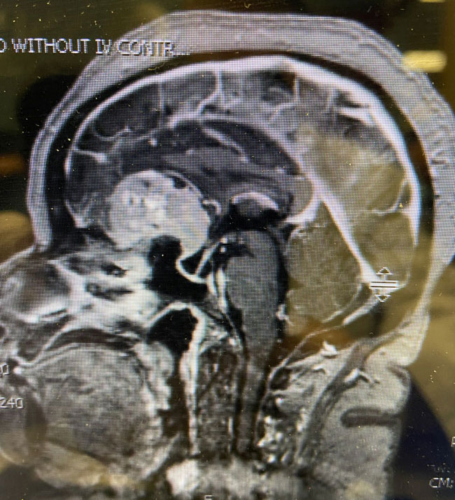 A woman with rapid deterioration in vision – Meningioma 1