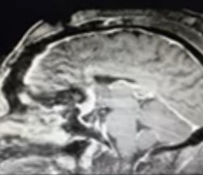 A woman with rapid deterioration in vision – Meningioma 4