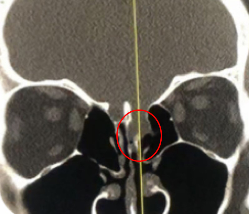 Coronal CT bone window