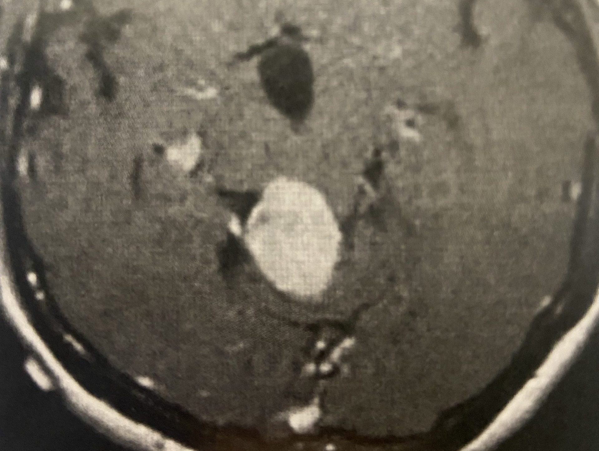 Pineal Region MeningiomaImage1 1 scaled e1643817820993