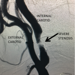 Unusual Indication for Carotid Stenting Over Endarterectomy 2