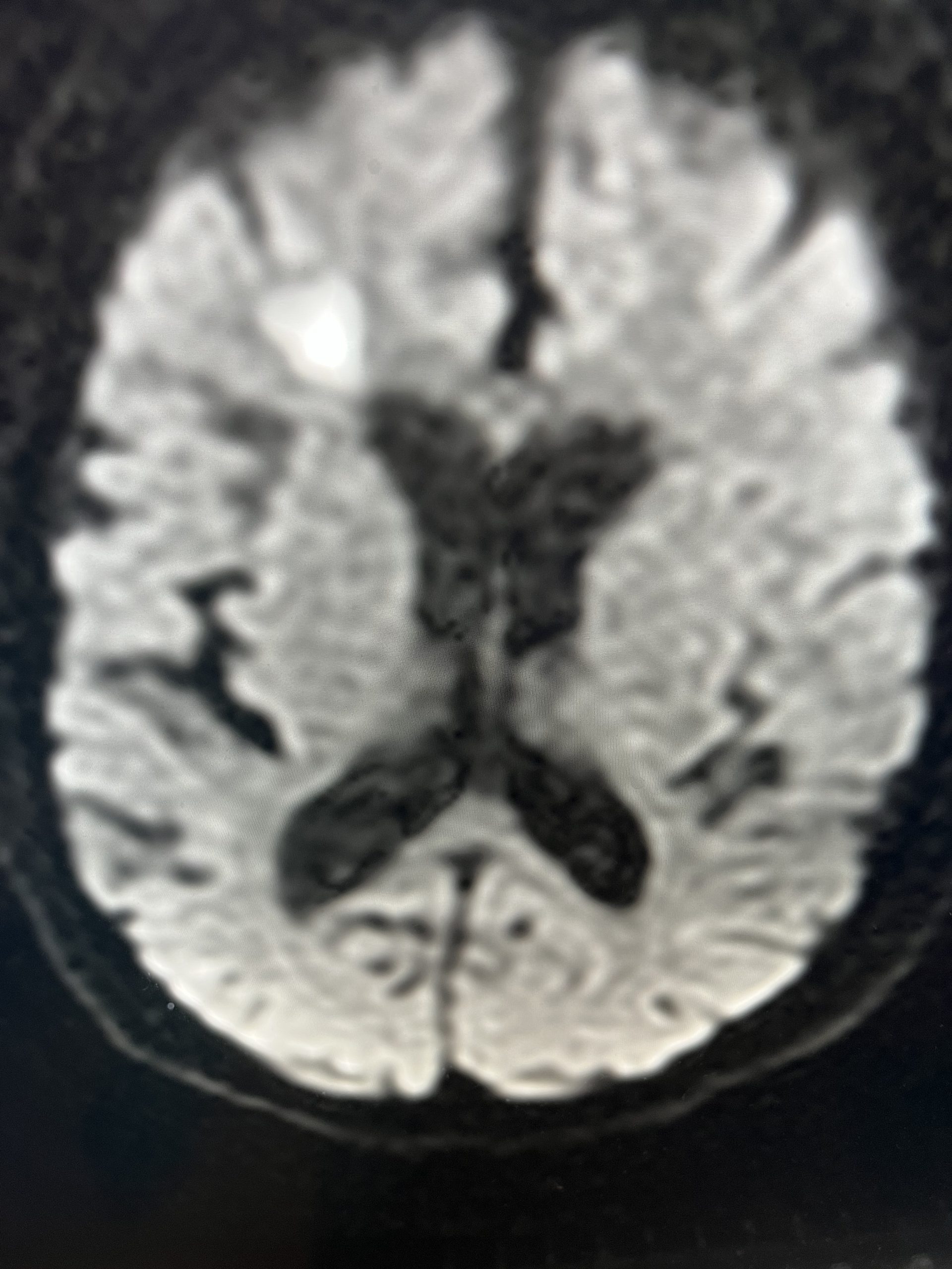 JLB Symptomatic Carotid Stenosis Fig. 1 Image scaled