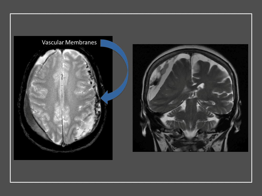 Neovascularized membranes within cSDH