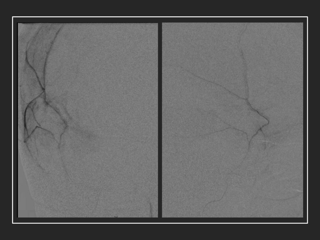 Dense contrast staining of vascular membranes during embolization